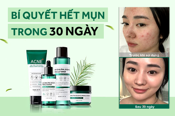 Bí quyết hết mụn trong 30 ngày với bộ sản phẩm SOME BY MI